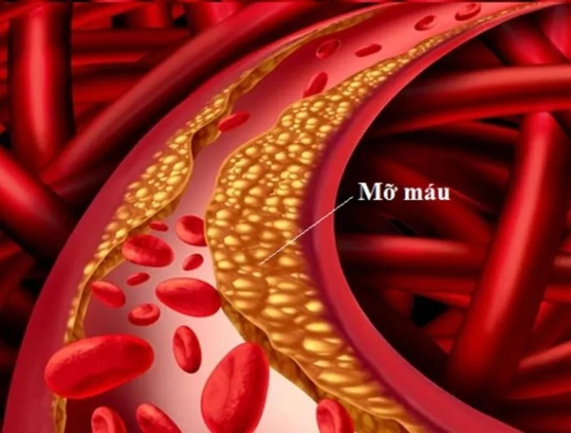 Mỡ máu cao được hiểu qua các chỉ số lipid máu như cholesterol toàn phần, LDL, HDL và triglyceride