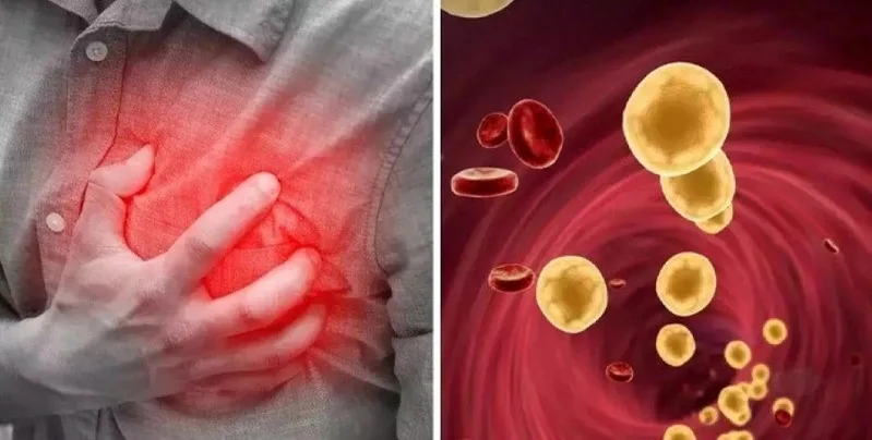 Mỡ máu cao có nguy hiểm vì có thể làm tăng nguy cơ xơ vữa động mạch, nhồi máu cơ tim và đột quỵ